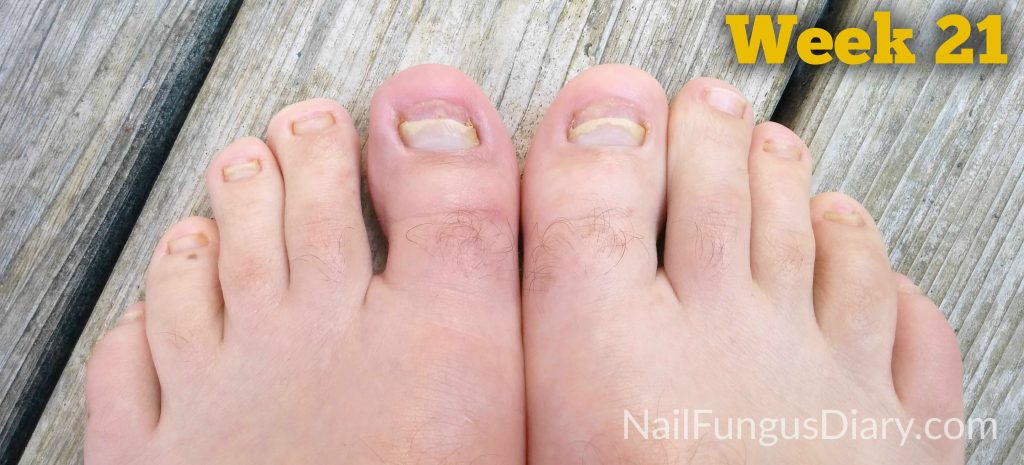 toenail fungus therapy over the counter